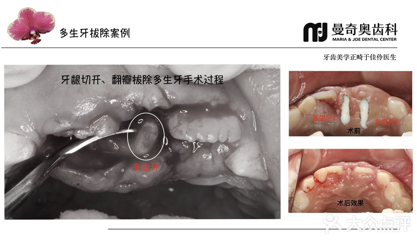 6岁的小朋友埋伏多生牙拔除案例