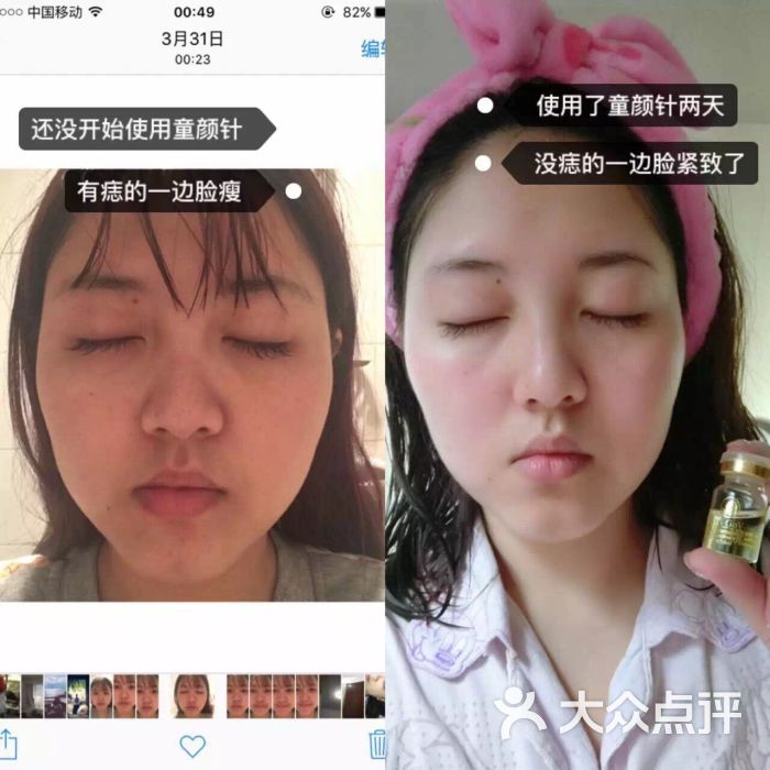 童颜针使用前后对比图,效果明显kandejian