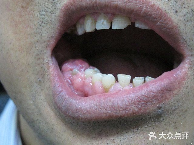牙龈增生是什么原因呢