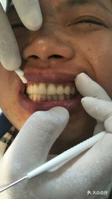 前牙6颗都是假牙,全瓷牙的效果