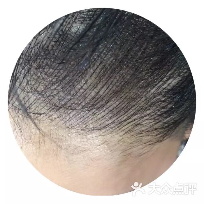 纹好的发际线