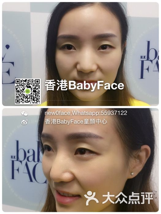 香港babyface韩式童颜中心(广州分公司)做完之后效果超好,不会变成