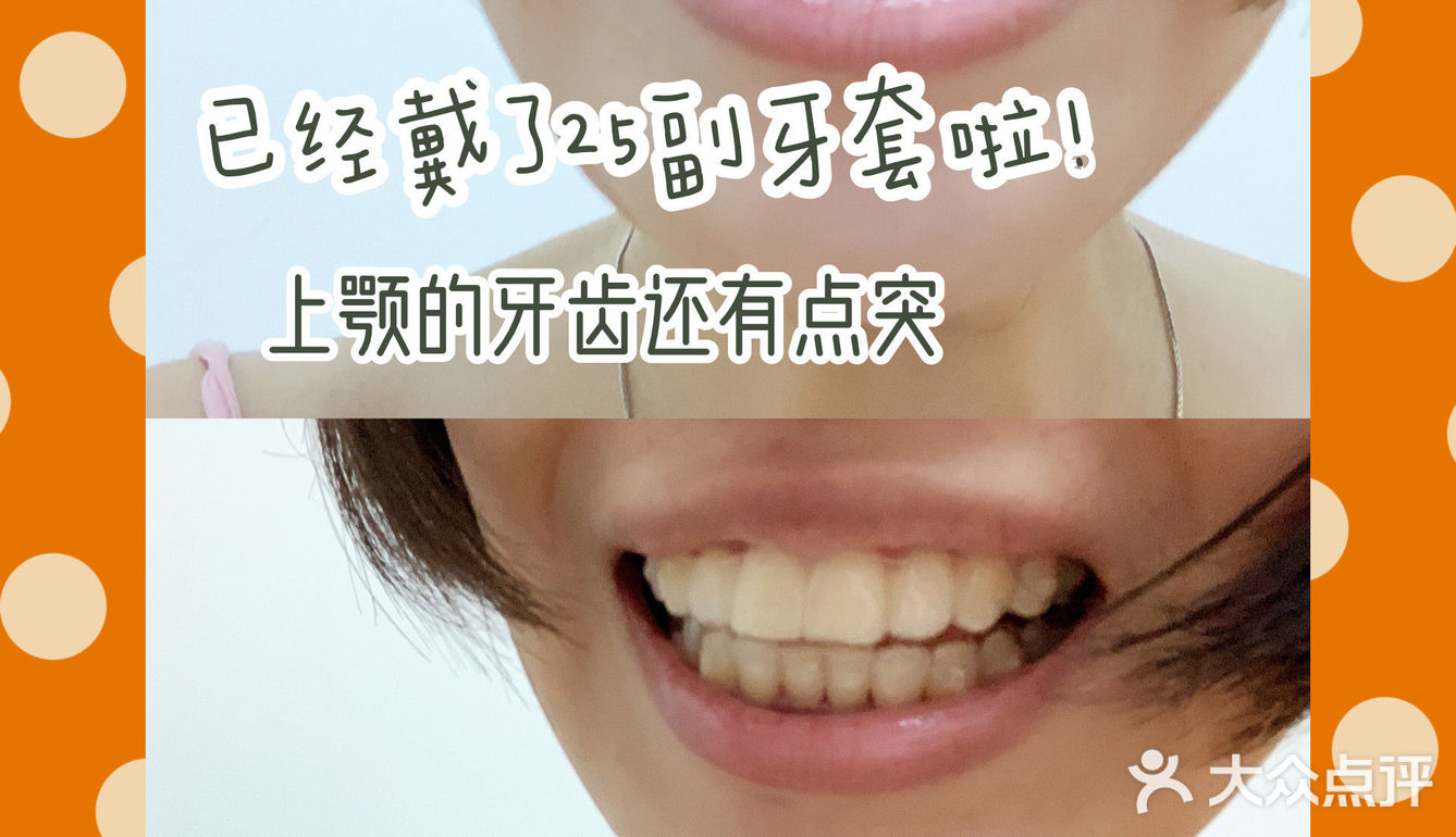 切片后的牙齿,牙缝会蛮大的,食物残渣容易欠在牙缝中