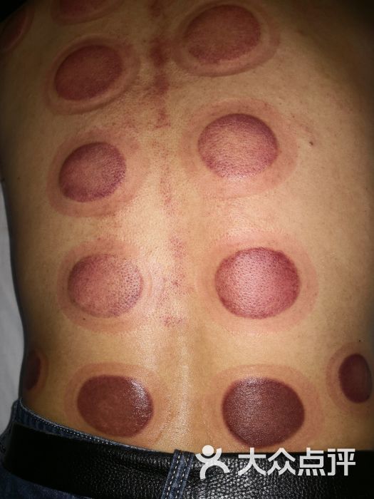 传古推拿:拔完火罐后的效果图。中午吃完饭.合