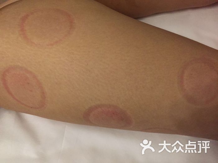 女人胳膊拔火罐位置图