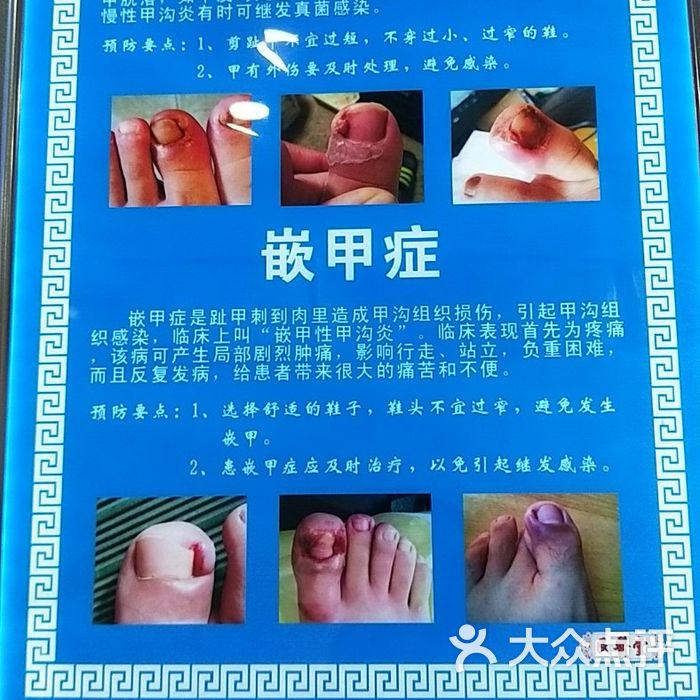 民医堂灰指甲