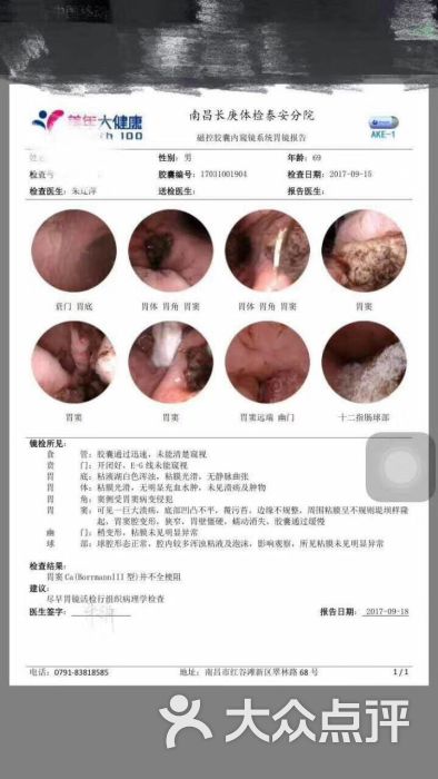 中国胃镜和日本胃镜体检上有哪些区别?