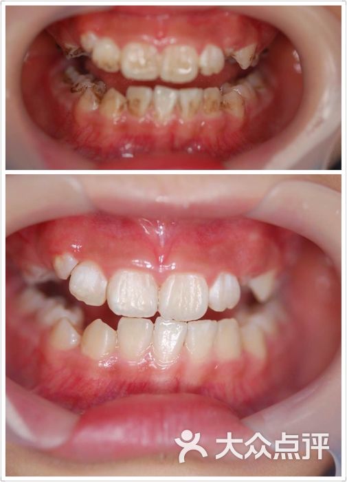 牙齿色素沉积,通过低频超声,去除.