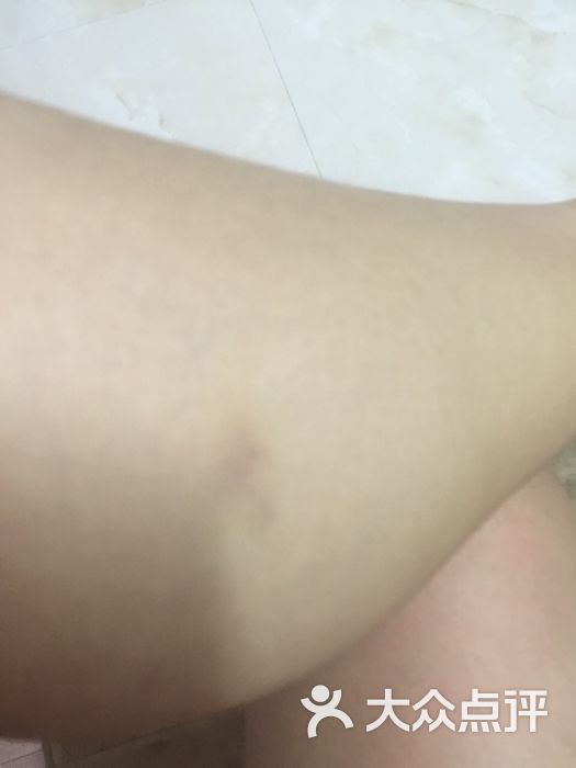 团购点评                          不好,昨天足浴,今天腿就青了一块