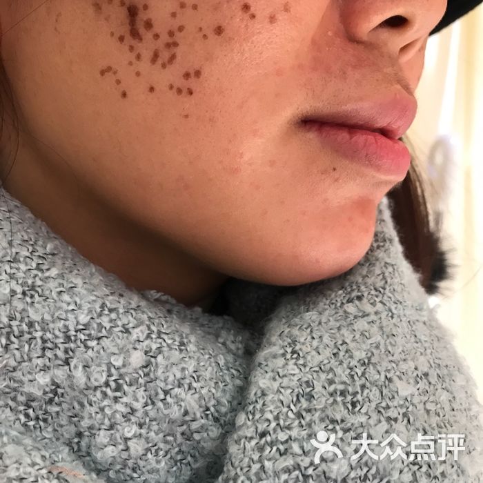 祛痣除斑祛痘修疤半永久眉眼唇