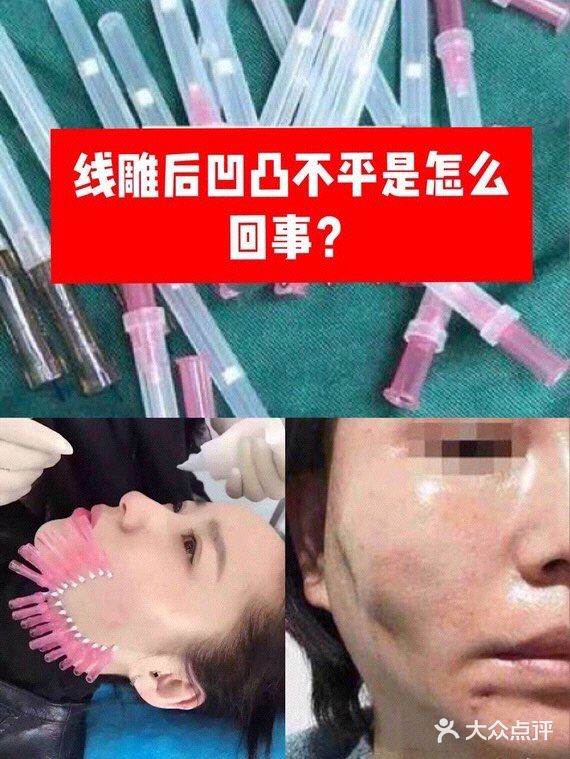 做完线雕后,脸上凹凸不平是怎么回事?