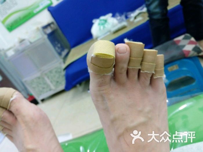 脚趾甲包住药膏的状态