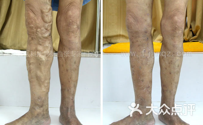 大隐静脉曲张