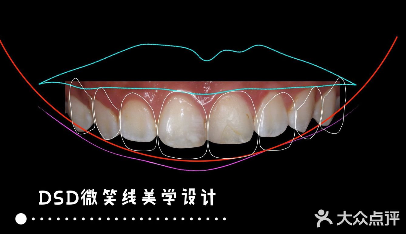 牙贴面的dsd微笑线是什么