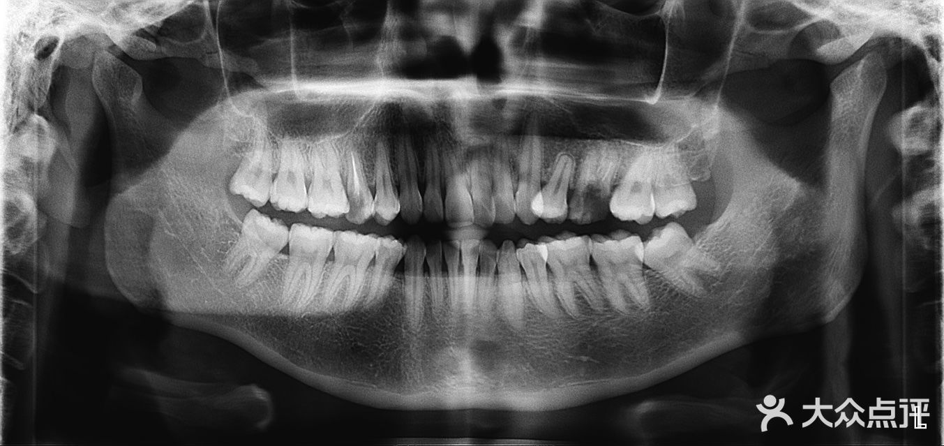 牙齿x光片 15年