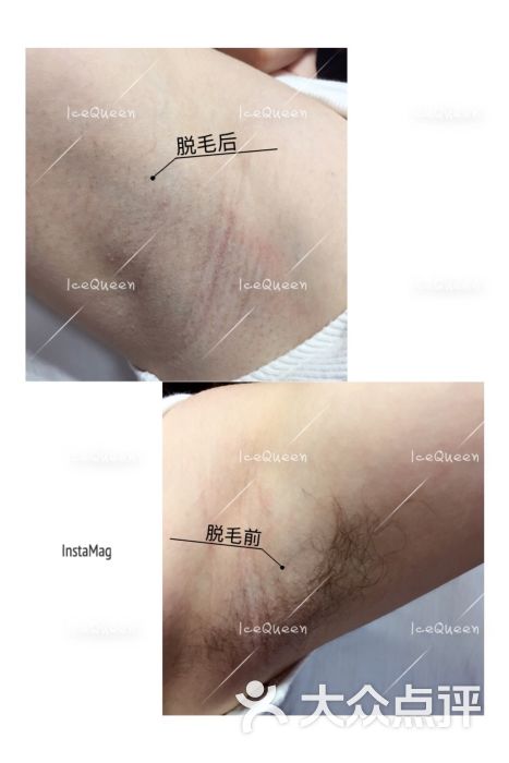 冰点脱毛