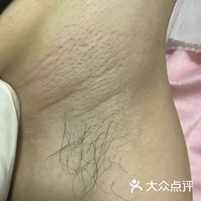 sister巴西热蜡比基尼wax图片-北京脱毛-大众点评网