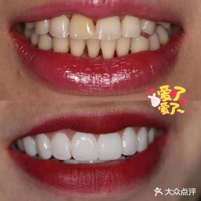 悦芽牙齿美白纳米全瓷贴面图片