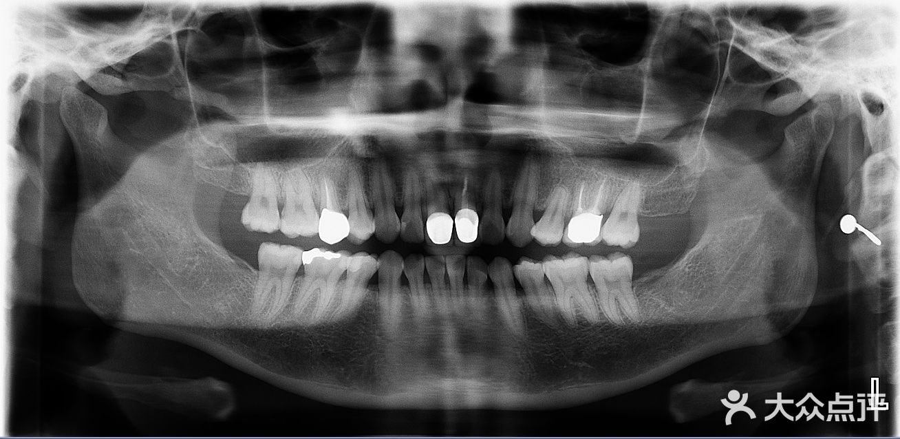 itooth爱牙齿科(嘉正口腔门诊部)牙齿x光片17年图片