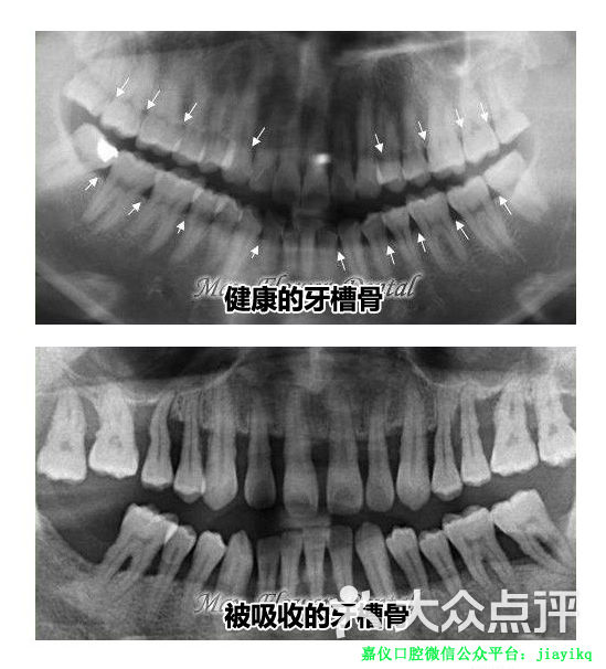 牙周炎治疗前后