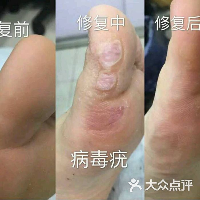 德哥灰指甲甲沟炎跖疣脚气手足癣