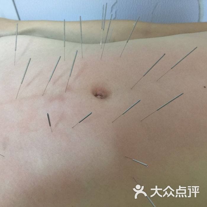 蜜糖针灸埋线瘦身工作室浦江镇减肥针灸塑型店