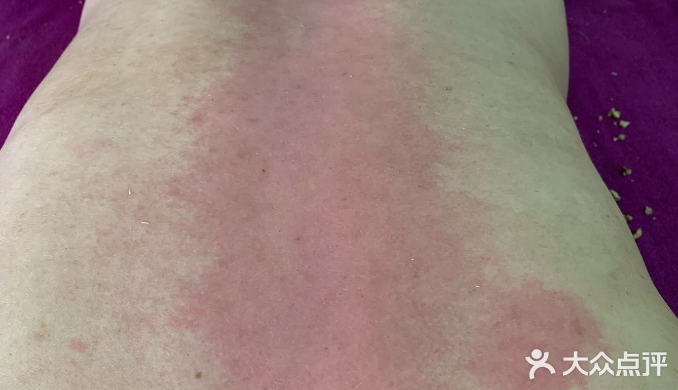 背上都红了,机师说是湿气特别重的表现