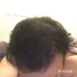 杭州植发医院排名_植发医院排名质丽网(3)