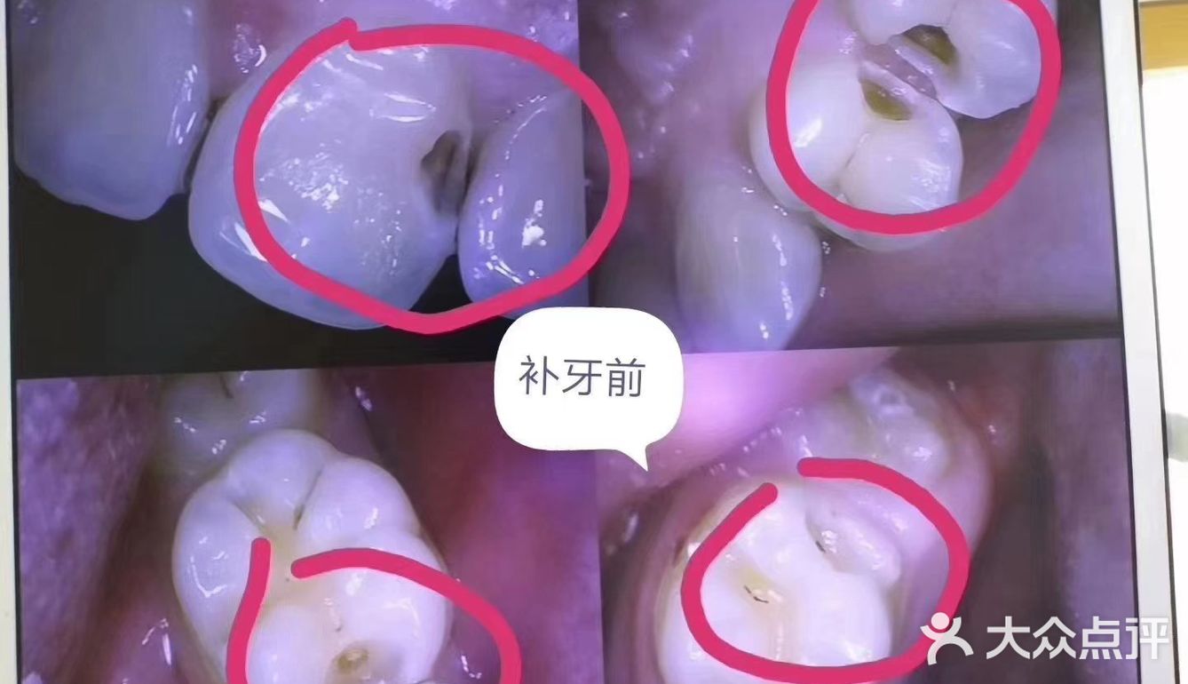 龋坏是什么意思