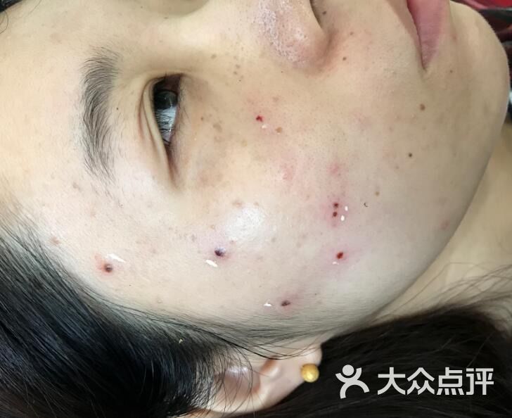 变美丽祛斑祛痘点痣祛痣店