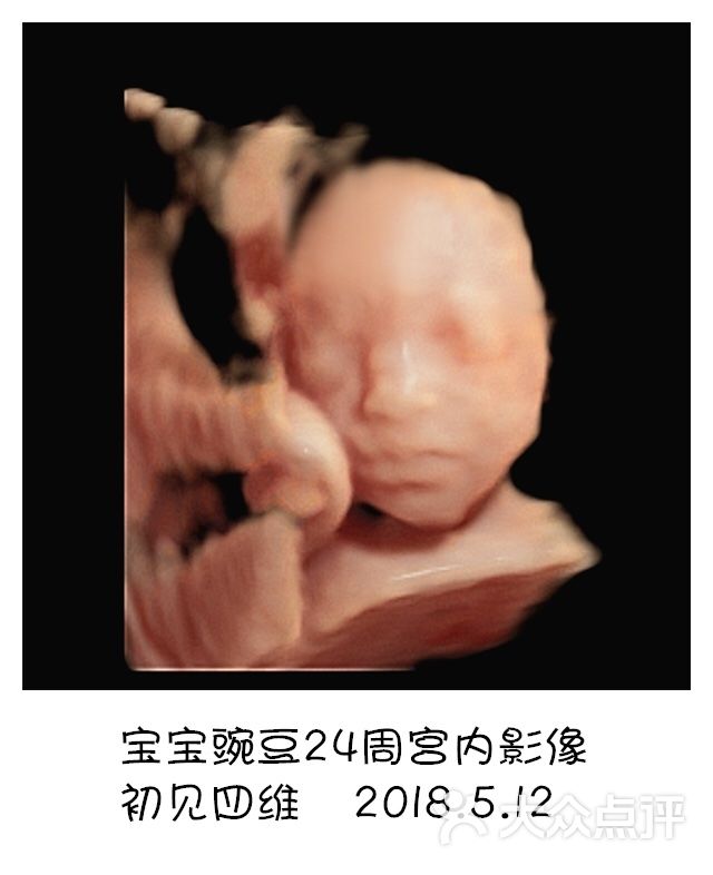 初见四维彩超五维彩超