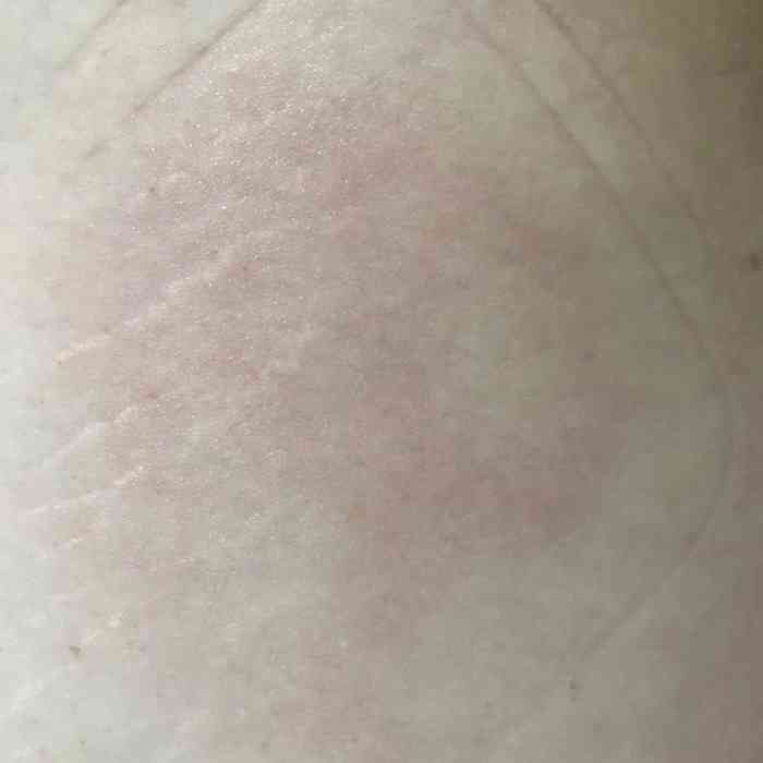 因为本人腿还蛮粗的,所以大腿位置有的肥胖纹,测完再详细给我介绍了一