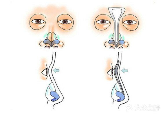 《那些事》最强鼻部整形术—鼻综合第二节鼻小柱延长术