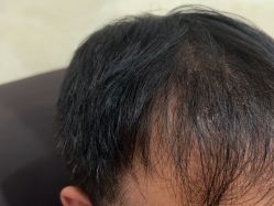 -碧莲盛·不剃发植发