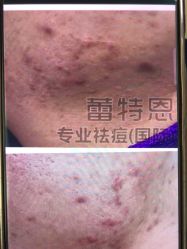 -蕾特恩专业祛痘·皮肤管理