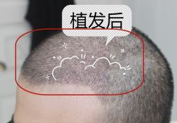 -大麦微针植发全国连锁