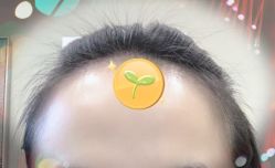 -大麦微针植发全国连锁