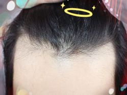 -大麦微针植发全国连锁