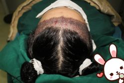 点击看大图 -大麦微针植发丨全国连锁