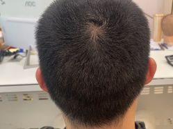点击看大图 -碧莲盛·不剃发植发