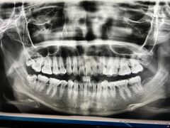 -赫尔森口腔·牙齿种植修复