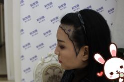 -大麦微针植发丨全国连锁