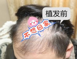 -大麦微针植发全国连锁