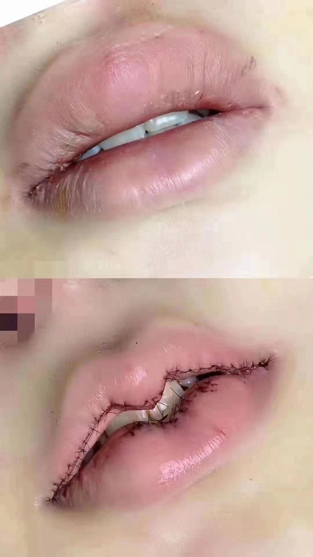 同乐医美,m唇案例