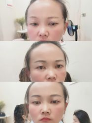 体验前-郡艺医疗美容·微整·眼鼻吸脂