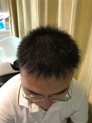 点击看大图 -大麦微针植发全国连锁