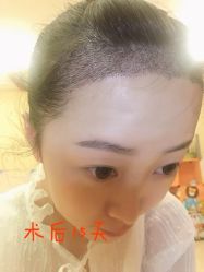 -大麦微针植发丨全国连锁