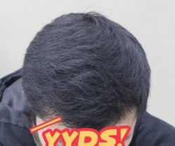 -大麦微针植发丨全国连锁