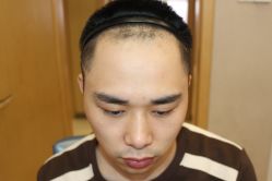 -大麦微针植发丨全国连锁