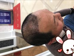 点击看大图 -大麦微针植发丨全国连锁